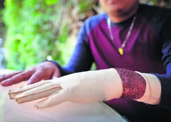 Tras incendio en Cd. Juárez, disculpa no sana sus heridas; “respirar me lastima”, dice migrante